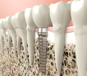 Dental implants at Shine Dental Newington