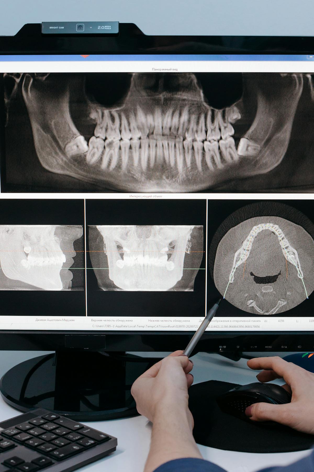 Dental X-ray showing jawbone for implant planning